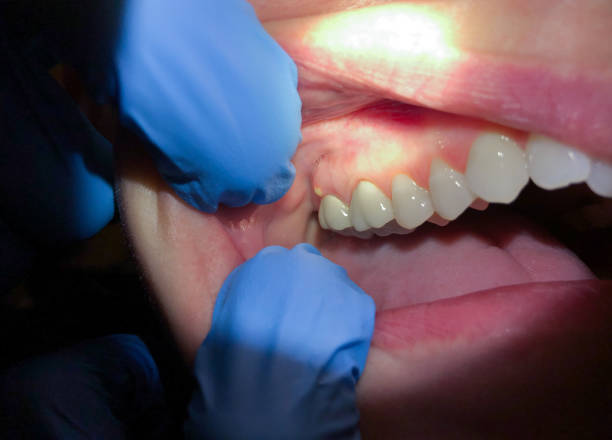 Best Knocked-Out Tooth (Avulsed Tooth) Treatment in King, NC